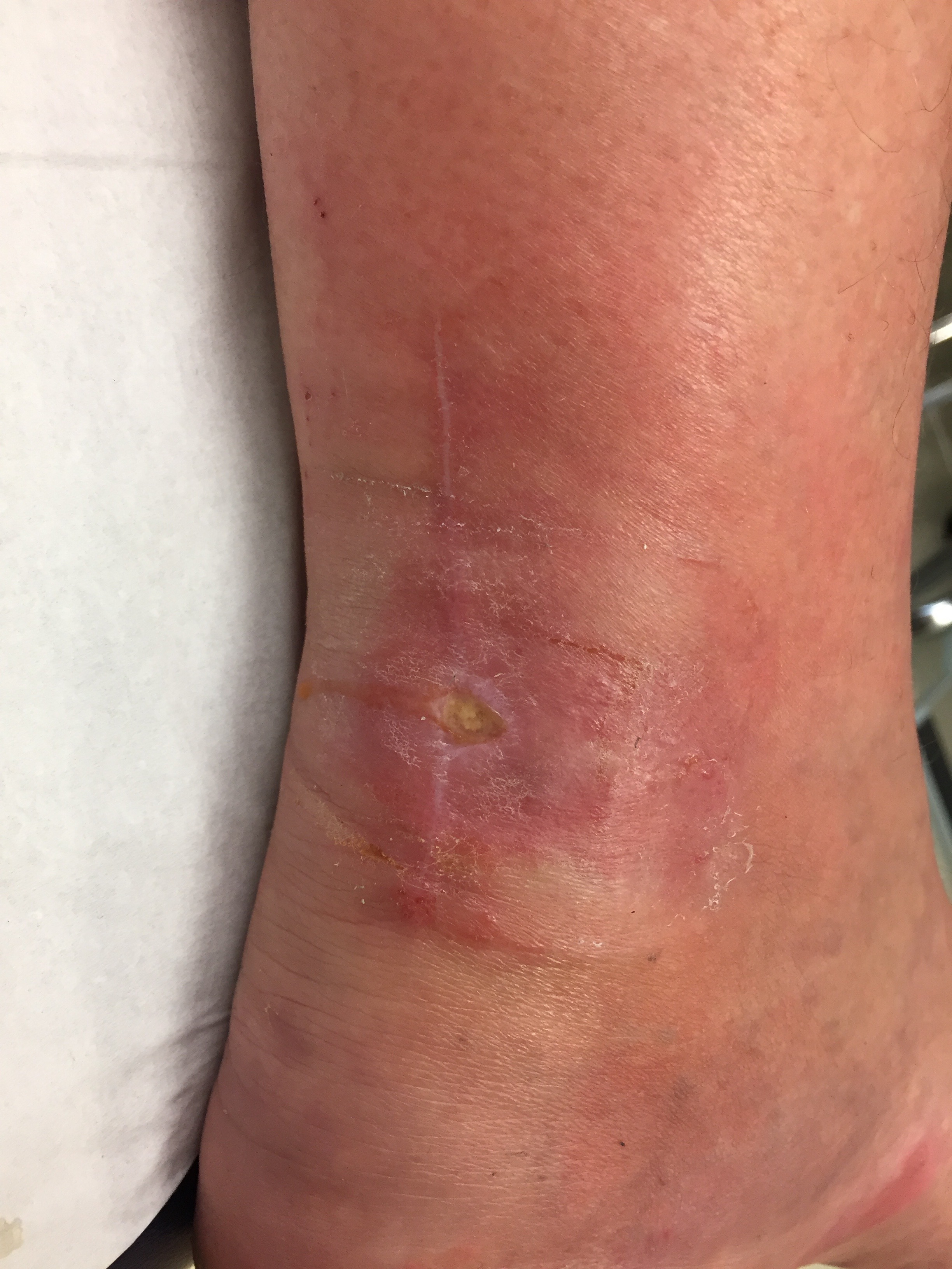 Infection post tendoachilles repair