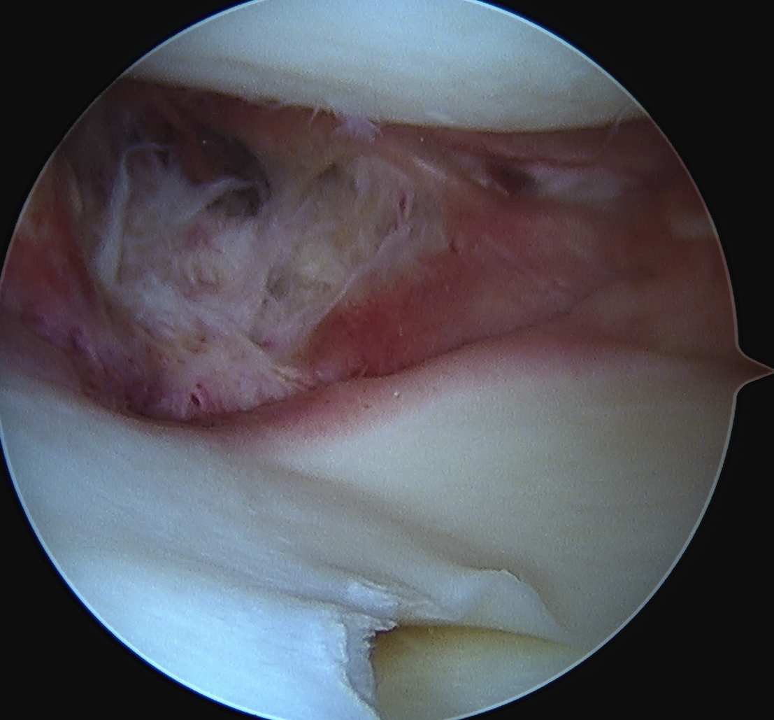 MCL injury arthroscopy