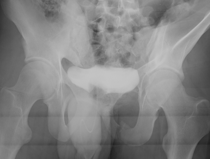 Pelvis Outlet View