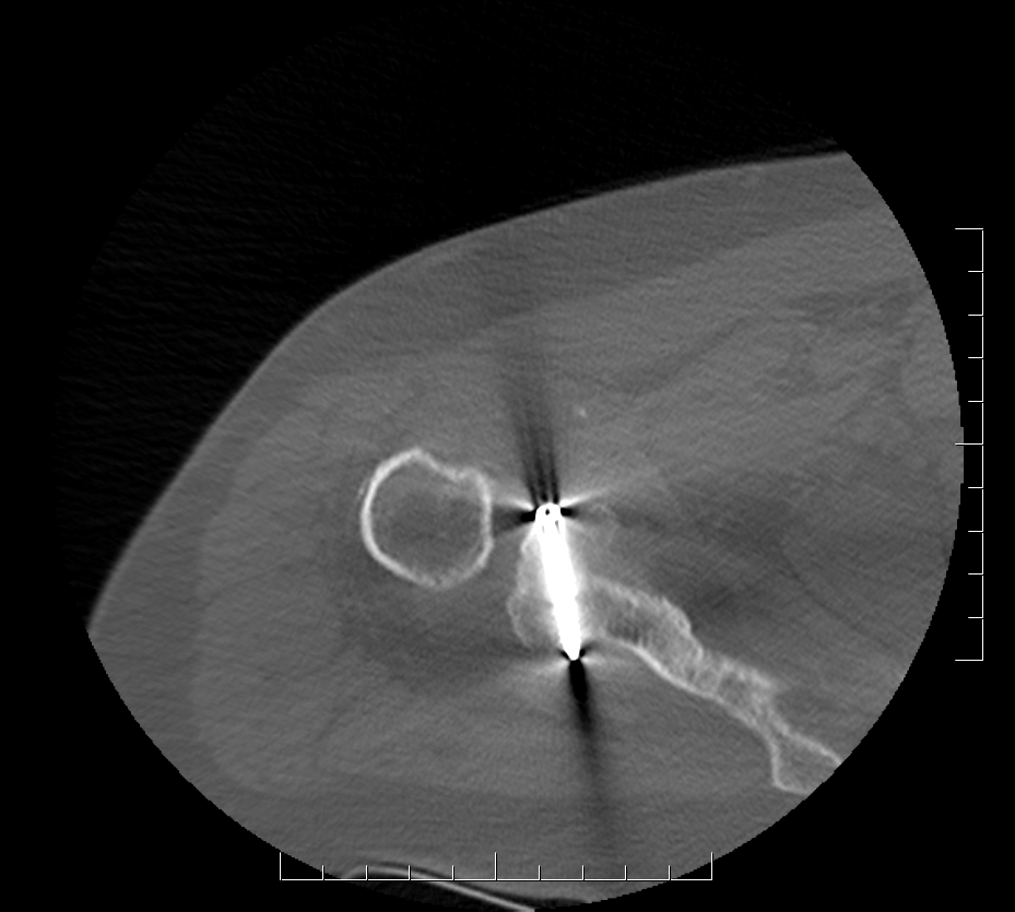 Humeral Head Autograft to Glenoid