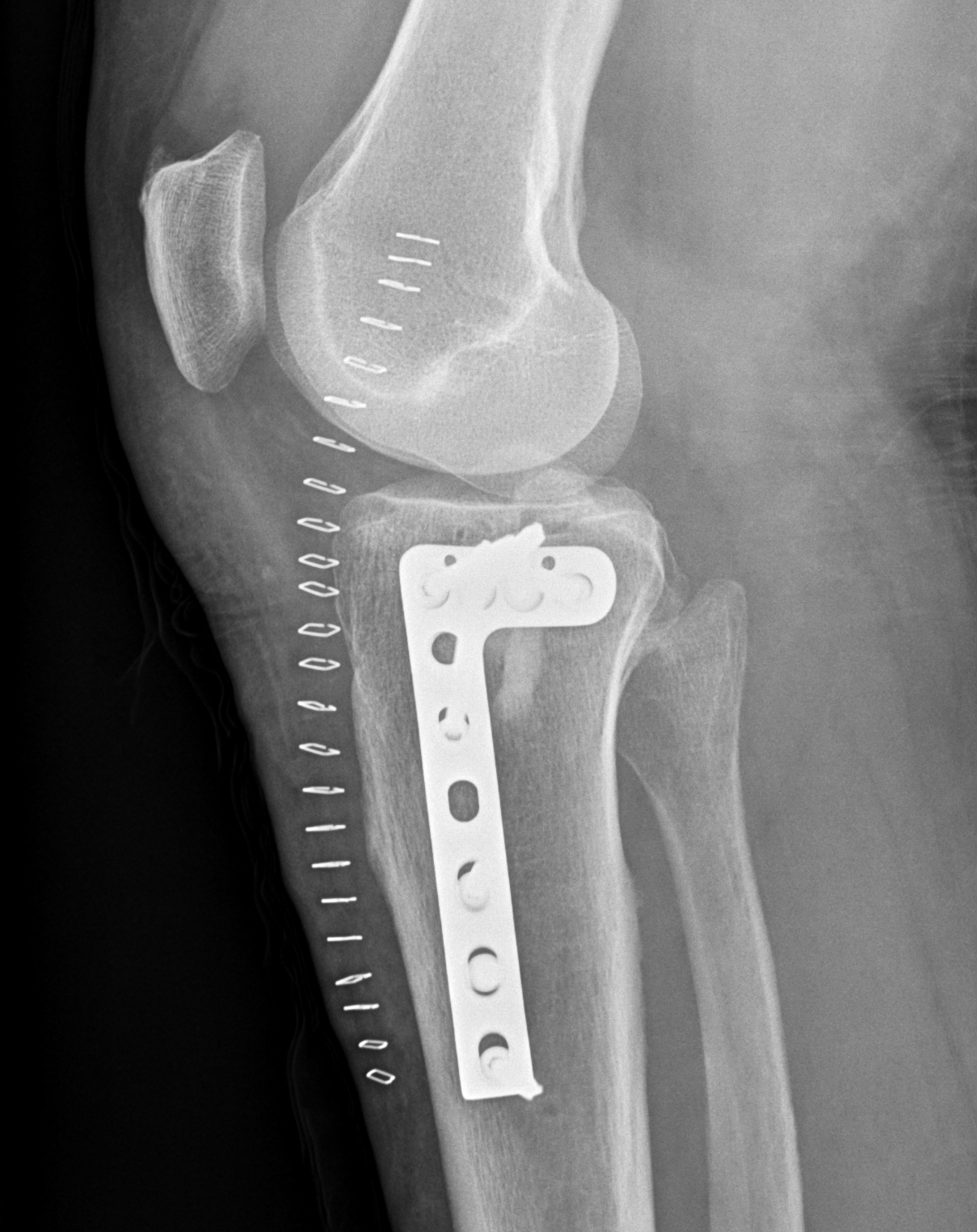 Type III tibial pateau ORIF III