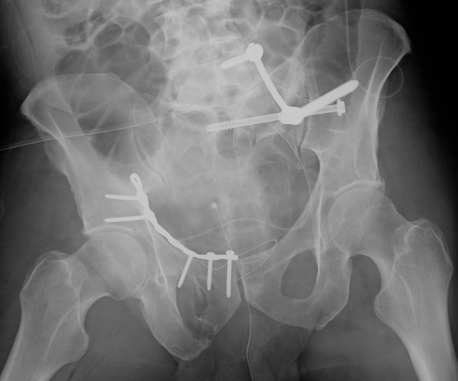 Lumbosacral fixation