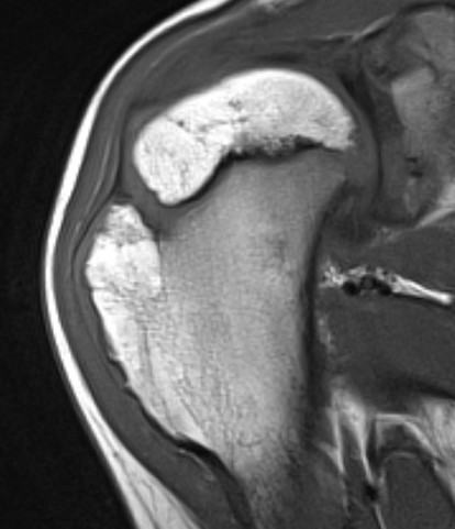 OC humerus MRI 1