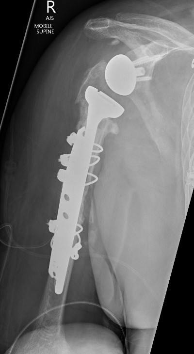 revTSA following fracture