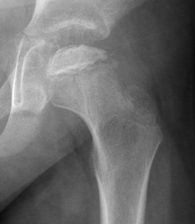 Lateral pillar
