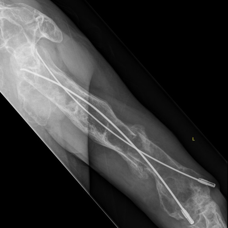 FD Humerus 2