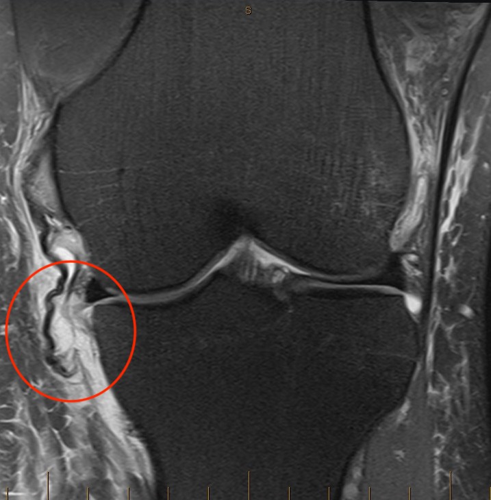 MCL tibial avulsion 2