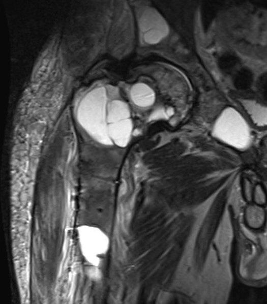 FD hip MRI