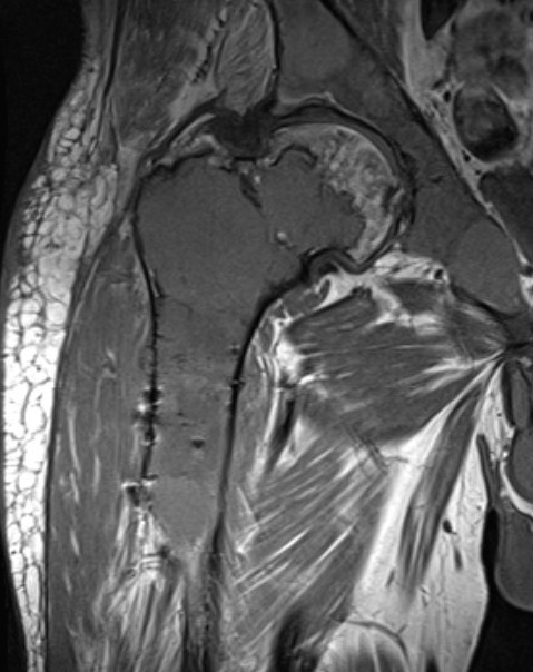 FD hip MRI 2