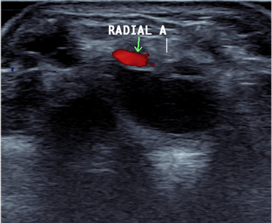 ganglion ultrasound