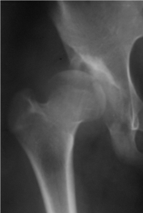 Chiari