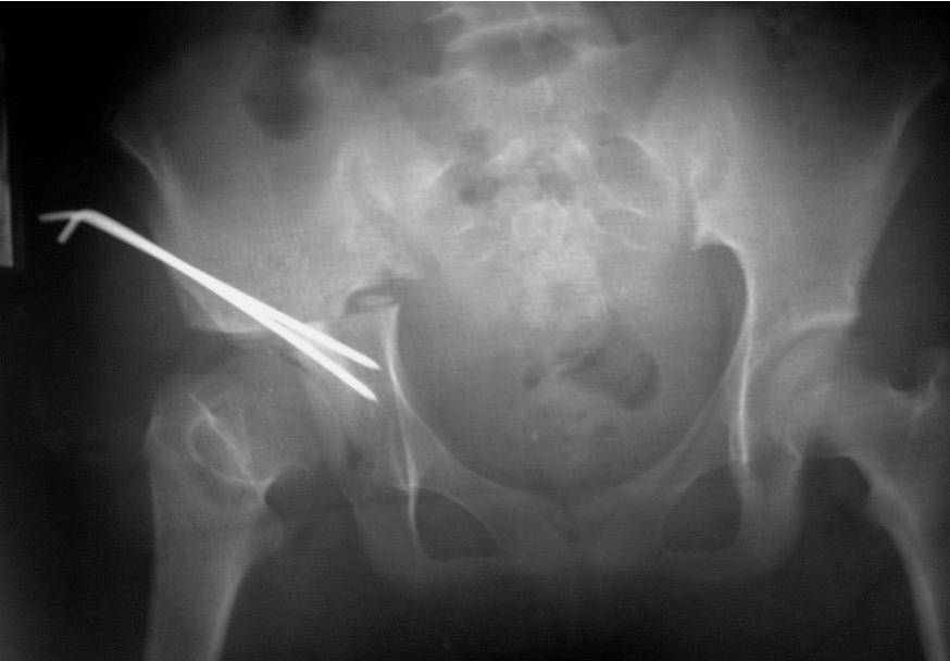 Chiari