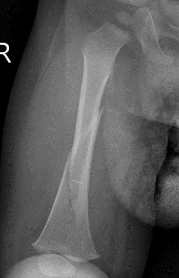1 month femur