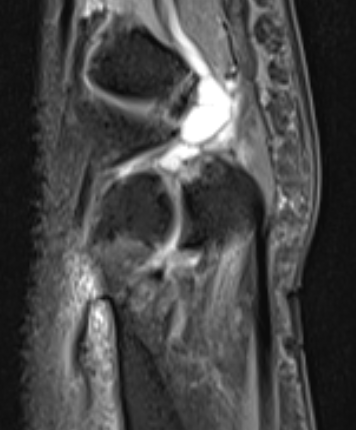 ganglion mri