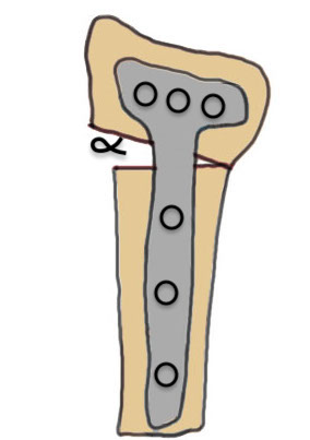 volar osteotomy
