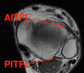 MRI