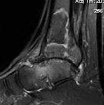 Ankle MRI