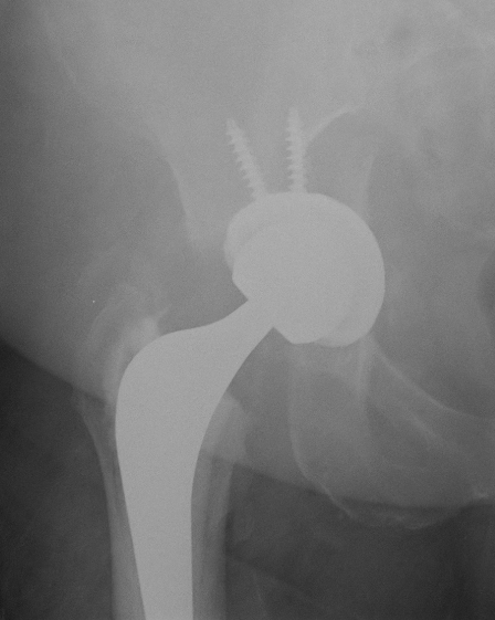 Intra-op acetabular fracture