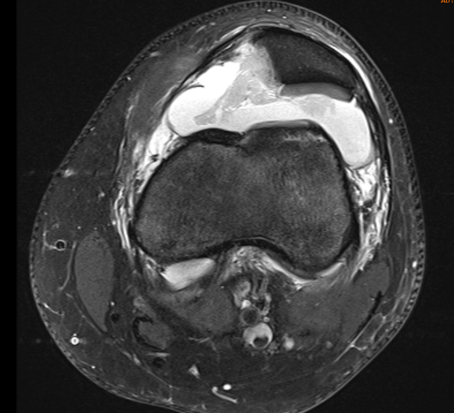 Medial facet
