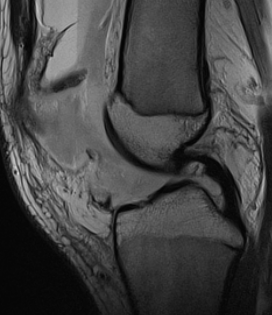 Medial facet