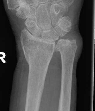 Radial malunion