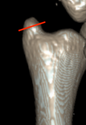 Ulna styloid