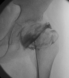 Arthro