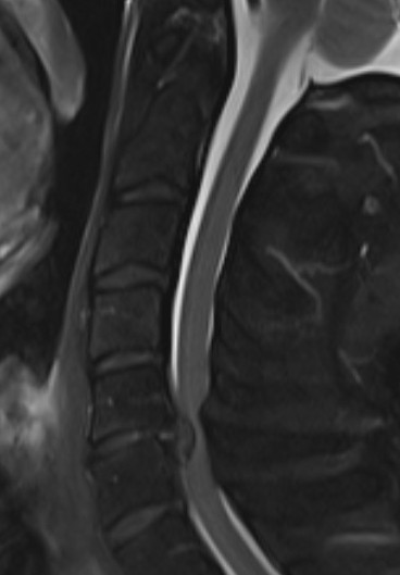 C stenosis