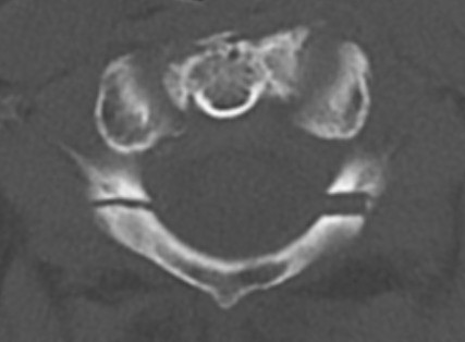 C1 posterior arch