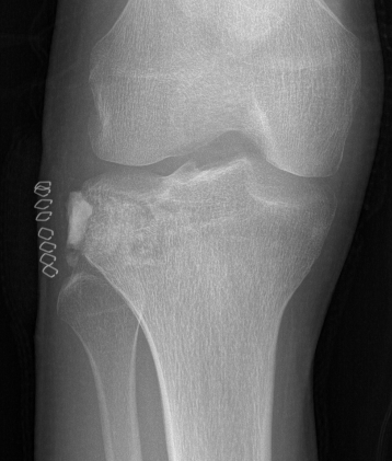 Chondroblastoma bone graft