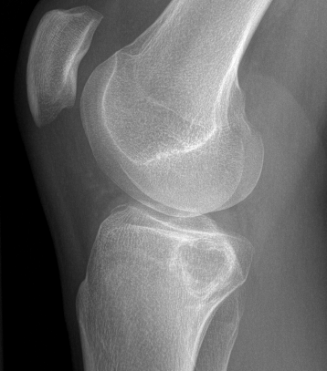 Chondroblastoma