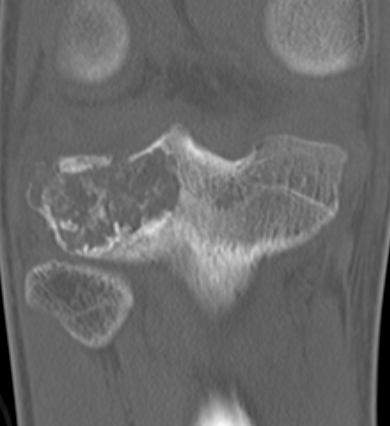 CT chondroblastoma 1