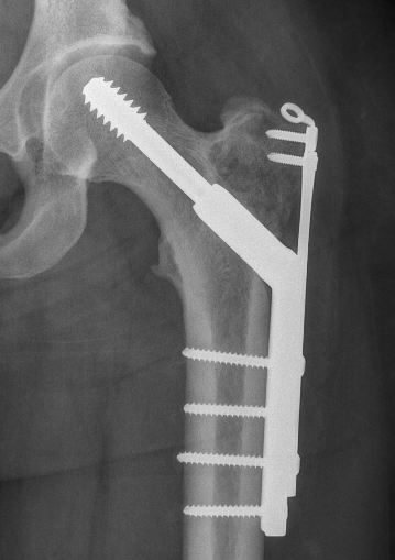 Chondroblastoma hip ORIF