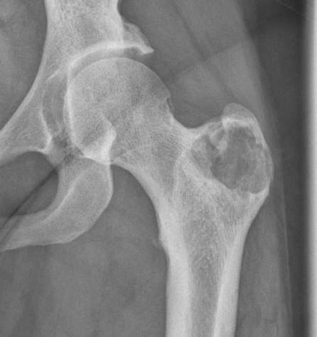 Chondroblastoma hip