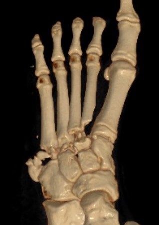 Lisfranc