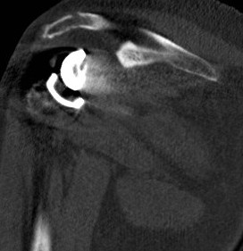 CT acromial stress fractures