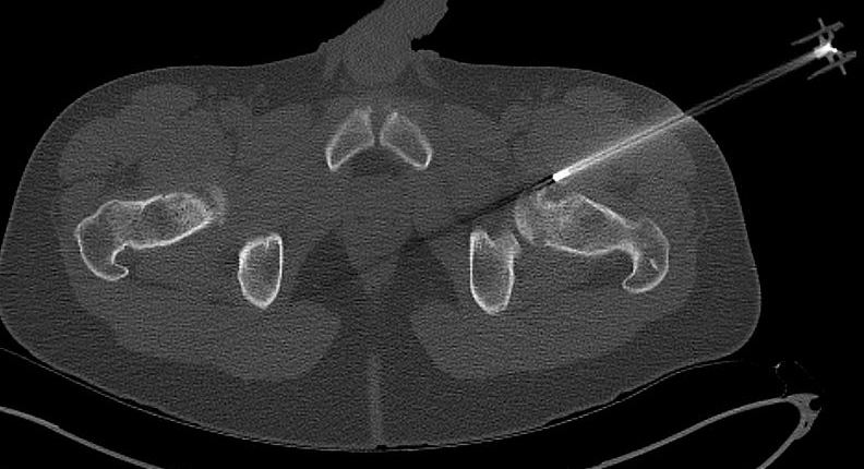 Biopsy periosteal chondroma