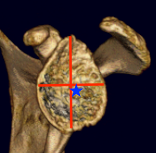 Glenoid center 2