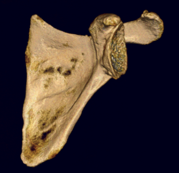 3D CT glenoid 1