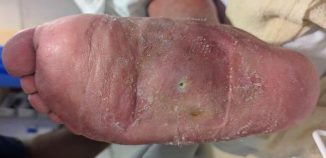 Charcot