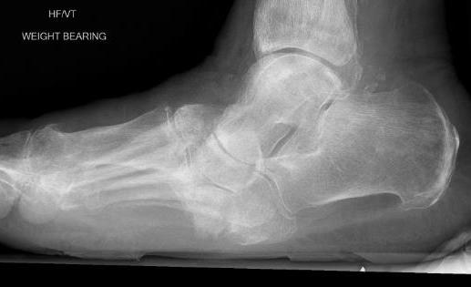 charcot