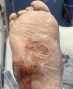 Ulcer