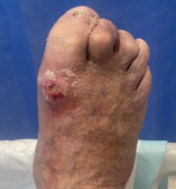 Ulcer