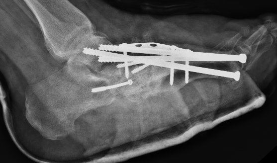 charcot