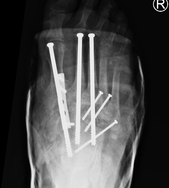 Charcot
