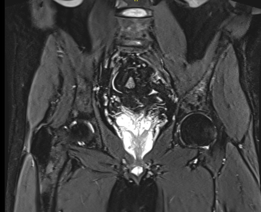 Chordoma MRI