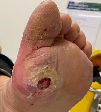 Ulcer