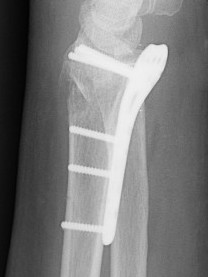 Flexor tendon rupture