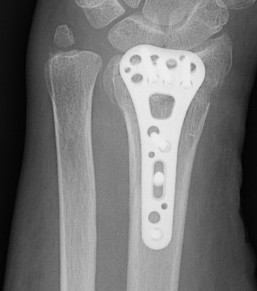 Flexor tendon rupture