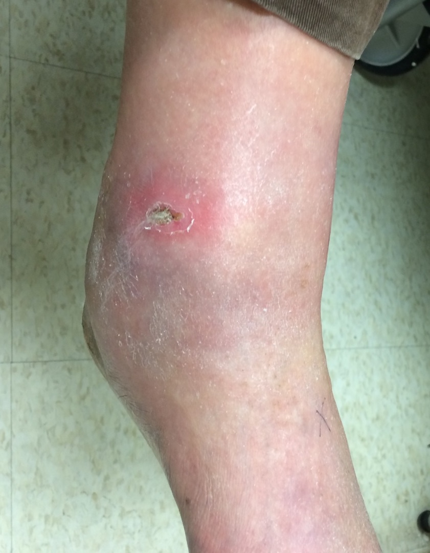 Ulcer